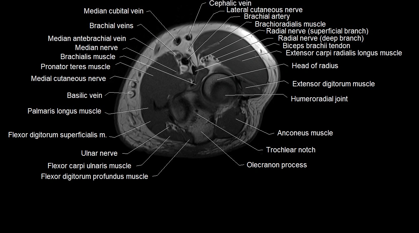 Upper arm( humerus) cross section anatomy MRI 3T axial image 57.webp